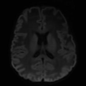 DWI shows no diffusion restriction in white matter
