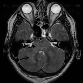 Axial T2 - weighted images showed high signal of the pons, the cerebellar, the midbrain, the basal ganglia and the thalami. T