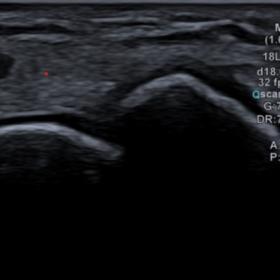Ultrasound scan. Preserved radio-lunar joint relation, without effusion or synovitis