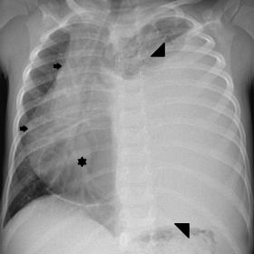 Chest radiograph shows almost complete opacification of the left lung on the anteroposterior view (a) (black arrowheads) with
