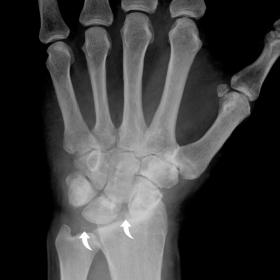 Posteroanterior left wrist radiograph shows a widening of the scapholunate interval (7mm) and osteoarthritis of the radioscap