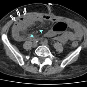 Axial CT without contrast. Intra-abdominal fluid collected in the RIF, with air inside, is seen (arrows) next to an ileal seg