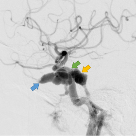 Initial conventional cerebral angiography demonstrates a direct type of carotico-cavernous fistula arising from the proximal 