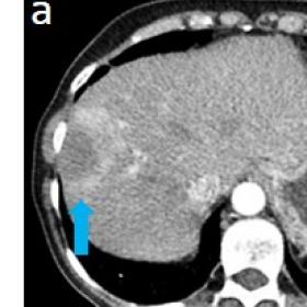 Multi-phasic CT in arterial, portal venous and delayed phase shows a 28mm lesion within subcapsular liver segment 8 in axial 