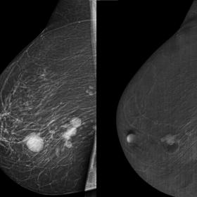 Dual-energy contrast-enhancement mammography. Right mediolateral oblique projection shows multiple rounded nodules in the low