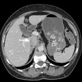 Axial contrast enhanced CT scan in portal venous phase showing solid enhancing mass lesion (white arrow) behind the portal ve