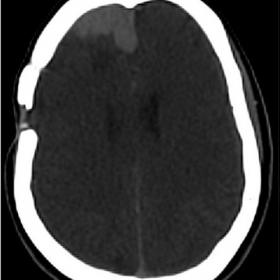 Axial CT Brain: Hyperdense nodular mass like, dural based lesion is seen along the falx and right high frontal region