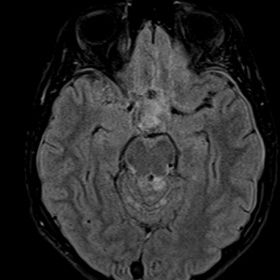Axial FLAIR-weighted image shows nodular hyperintensities located at the suprasellar and cuadrigeminal cysterns. There is als