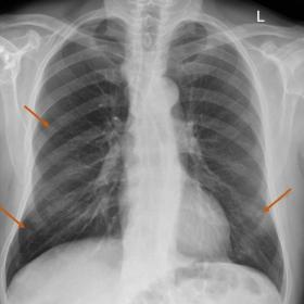 Chest X-Ray in the posterior – anterior projection, marking three radio-opaque nodular lesions in the right middle lung fie