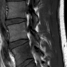 Sagittal T1 (A), T2 (B), STIR (C) and T1 after Gadolinium injection with fat suppression depict the pathologic tissue involvi