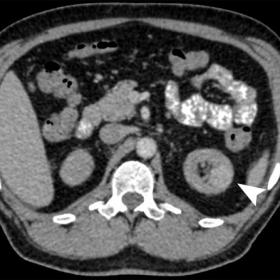 Axial contrast-enhanced CT image (A) showing the enhancing lesion (arrowhead) on the left renal cortex. Sagittal contrast-enh
