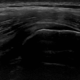 Ultrasound imaging showed no signs of tendinopathy, no hydrops in the hip joint, no swelling of the throchanteric bursa, and no apparent signs of bleeding
