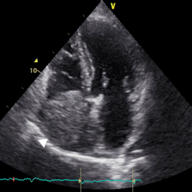 Transthoracic echocardiogram in apical 4-chamber view: the right atrium was dilated and occupied by a large, heterogeneous ma