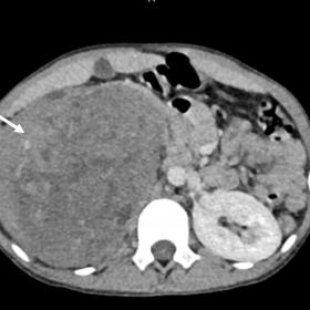 Axial post contrast image shows heterogeneously enhancing mass lesion completely replacing almost the  entire right kidney(wh