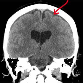 Non-contrast CT brain showing bilateral subdural collections at the right posterior frontal/parietal lobes and small componen