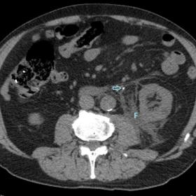Axial reconstruction of abdominal non-enhanced CT showing a 3 mm calculus (arrow) in the left ureter at its proximal third an