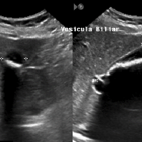 Multiple stones inside the gallbladder shown in the abdominal ultrasound