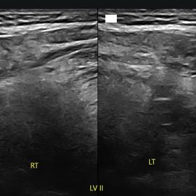 Longitudinal ultrasonogram of right (RT) and left (LT) submandibular regions / Level II (LV II) showing absence of bilateral 