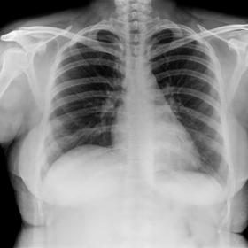 Chest x-ray PA view done 2 years before the presentation – Unremarkable cardia and lungs. The diaphragm is normal in positi
