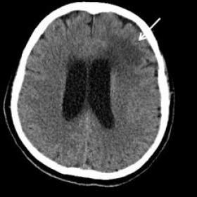 Description: Brain CT shows a hypodense lesion on the left frontal lobe (arrow)