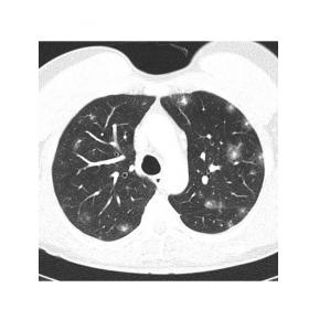 Axial post-contrast CT thorax in lung parenchymal window: multiple and bilateral lung nodules with halo sign