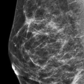 Mammography. Mediolateral oblique (MLO) view of the right breast (A) and left breast (B). Craniocaudal (CC) view of the right