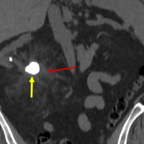 Coronal non-contrast CT scan showed an extensive right-side peri-renal expanse (red arrow) with a large mixed attenuation, pr