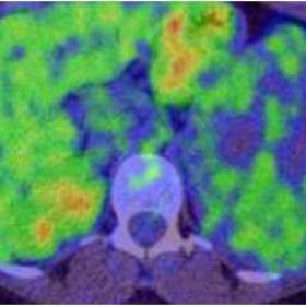 Axial PET CT image shows no significant uptake in the splenic lesion