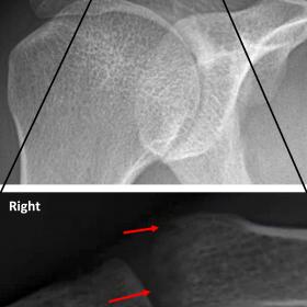 Radiograph image of the right shoulder with enlarged view of the acromioclavicular joint. Description: Notice the periarticular osteopenia and the irregular articular surface (red arrows) of the distal clavicle in the pathologic right side