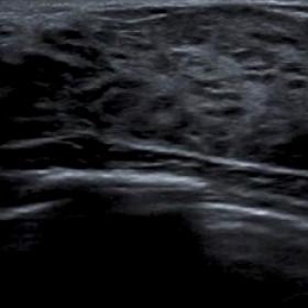 Ultrasound showing asymmetrically enlarged dense heterogenous fibroglandular tissue in the right breast (A= right breast, B= left breast)