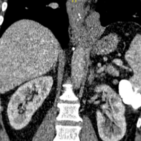 54 year-old-male presented with an incidental finding on CT Virtual Colonography of an extensive serpiginous soft tissue nodu