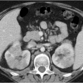 Multislice contrast enhanced CT in nephrographic phase- bilateral hypoenchancing renal nodular lesions and retroperitoneal an