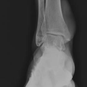 Anteroposterior radiograph of the right ankle shows an ill-defined soft tissue density lesion in the medial aspect. Visualise