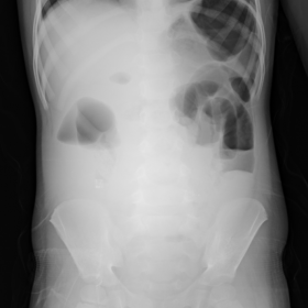 Erect abdominal radiograph shows multiple air-fluid levels in the left upper quadrant.