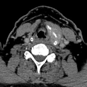 CT scan of the neck (a,b: axial, c: coronal) reveals an irregular moderately enhancing mass centred on the left thyroid carti