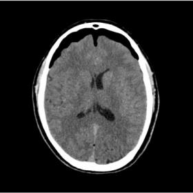 Axial CT scan revealing extra-axial air collection at bilateral anterior frontal region - Mount Fuji sign indicating tension 