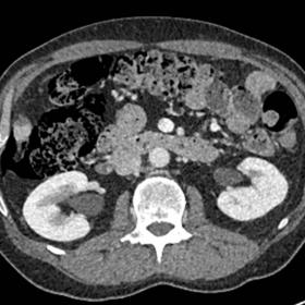 CECT in portal venous phase showing gas bubbles within right ascending colon wall extending in the right pararenal space  (ar