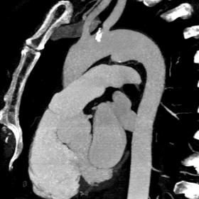 MIP projection sagital (a), axial(b) and VRTimages (c) show focal aortic wall bulge that meets aortic wall with a shorter, st