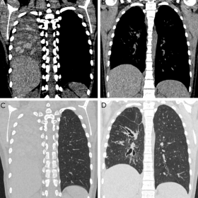 Chest CT in coronal reformation in mediastinal (panels A, B) and parenchymal (panels C, D) reformations, before (A, C) and af