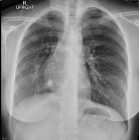 Chest radiograph showing right lung volume loss evidenced by slight shifting of the mediastinal structure to the right. Note 