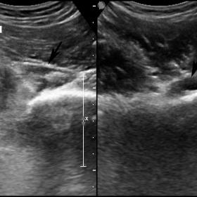 Ultrasound of the pelvis in trasverse and oblique planes. A small hypoechoic area (arrows) is present between the iliac muscle (IM) and the maximum gluteus (MG).