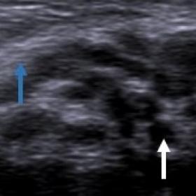 Transverse axis (a) and longitudinal axis (b) sonography images of left distal forearm and hand showing median nerve enlargem