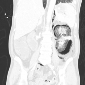 Pre-intervention coronal CT abdomen with lung windowing showing enlarged and destroyed left renal parenchyma with gas fluid l