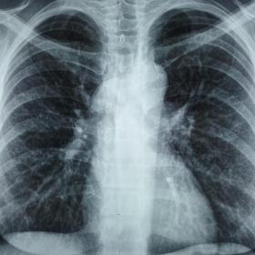 The initial chest x-ray. Right-sided widened mediastinum