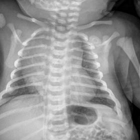 A radiograph which demonstrates a normal prominent thymus with the wave sign along both mediastinal borders seen as undulatio