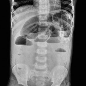 Radiograph of the abdomen in AP view and erect posture shows multiple dilated bowel loops with air-fluid levels, suggestive o