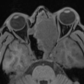 T1w a) axial b) coronal image showing T1 hypointense mass in the left sinonasal cavity