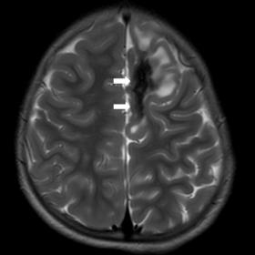 Axial T2W (a), FLAIR (b) and coronal T2W (c) images show a giant T2 hypointense cortical-subcortical tuber (white arrows) wit