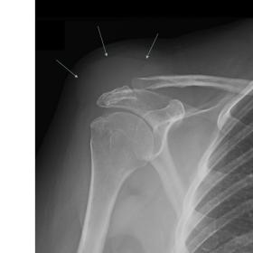 Anteroposterior X ray of the shoulder. Soft tissue mass overlying the acromioclavicular joint (arrows)