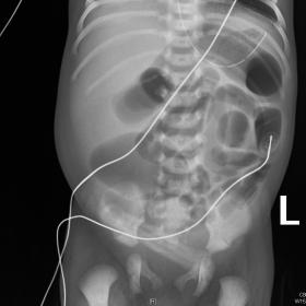 “Abdominal radiograph”, Supine AP radiograph showing abdominal distension.